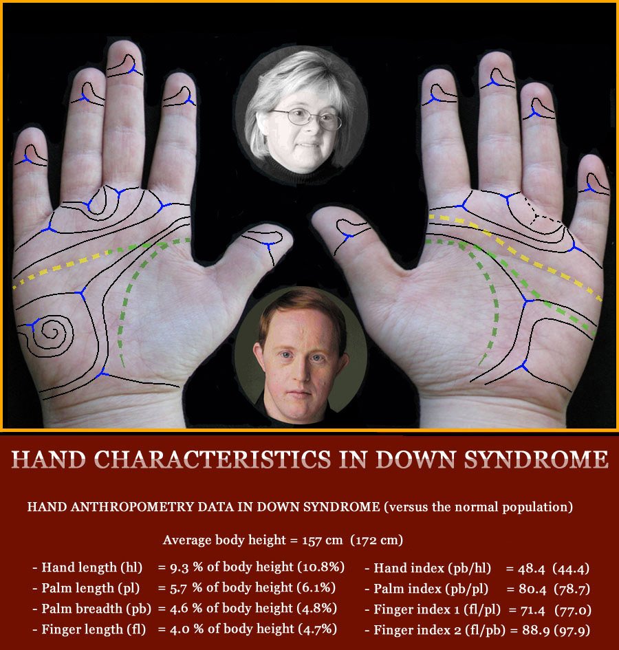 The hand in Down syndrome - multi-perspective palm reading.